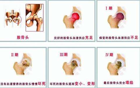 股骨头坏死
