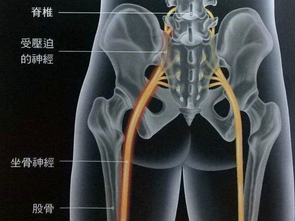 坐骨神经痛有哪些症状结合预防方法